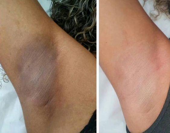 dark under arms treatment