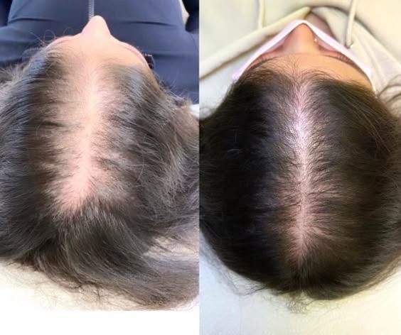 hair fall treatment